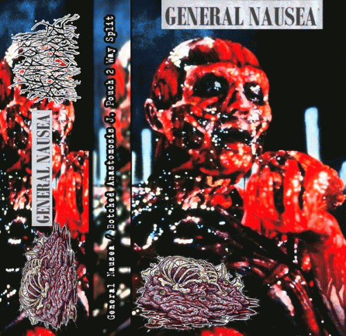 Botched Anastomosis J-Pouch : Botched Anastomosis J-Pouch - General Nausea